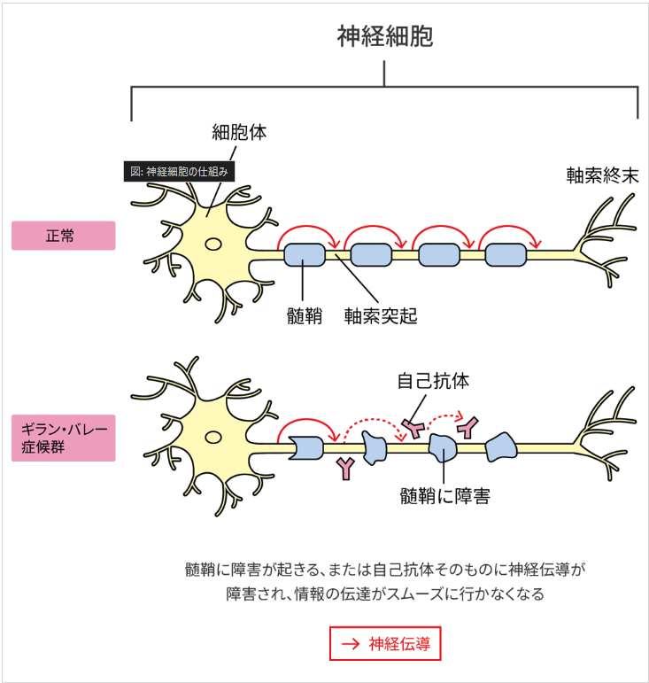 ギランバレー症候群